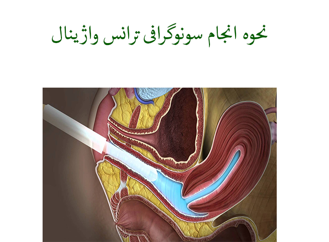 سونوگرافی ترانس واژینال