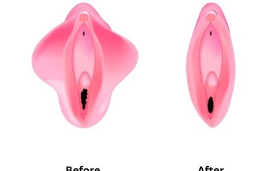 عکس قبل و بعد لابیاپلاستی